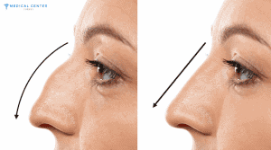 Why Choose Turkey For a Nose Job in 2025 ?