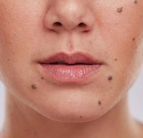 Can I Remove Moles Without Scarring in Turkey?