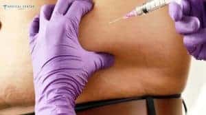 A Comprehensive Guide to Fat Injection Procedures in 2025