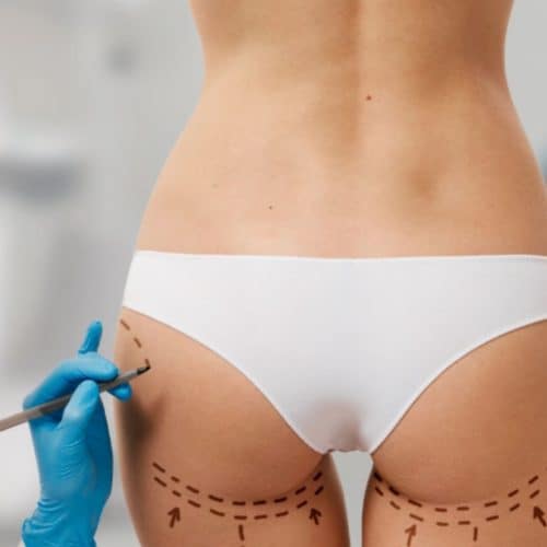 Why Is BBL in Turkey So Popular?