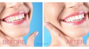 Can I Fix My Smile in Just One Trip to Turkey?