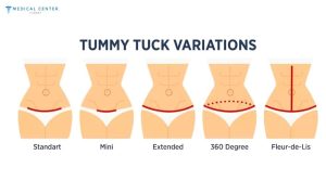 Why Do Patients Travel to Turkey for Tummy Tucks?