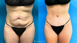 Why Do Patients Travel to Turkey for Tummy Tucks?