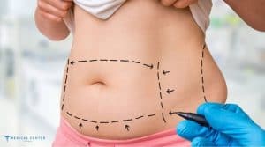 Why Do Patients Travel to Turkey for Tummy Tucks?