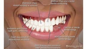 Can I Fix My Smile in Just One Trip to Turkey?