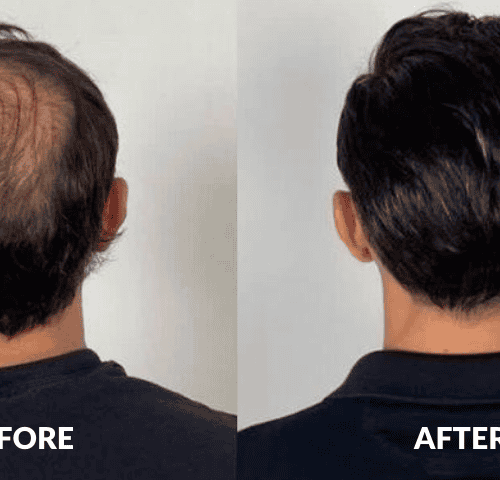 Paul's Hair Transplant Experience in Turkey