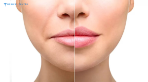 Do Lip Fillers Still Look Natural in 2026?