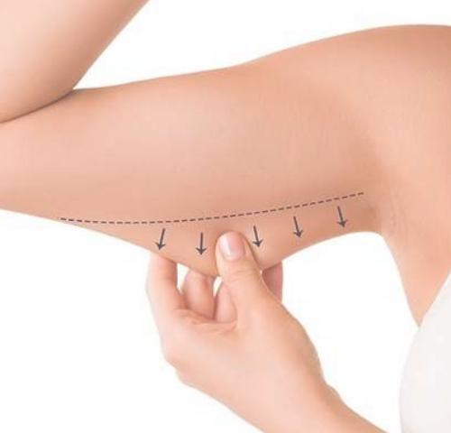 What Are the Expected Result of an Arm Lift in Turkey