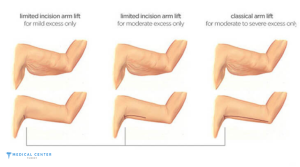 What are the Expected Result of an Arm Lift in Turkey?