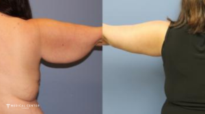 What are the Expected Result of an Arm Lift in Turkey?