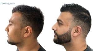 Beard Transplants Are Booming in Turkey