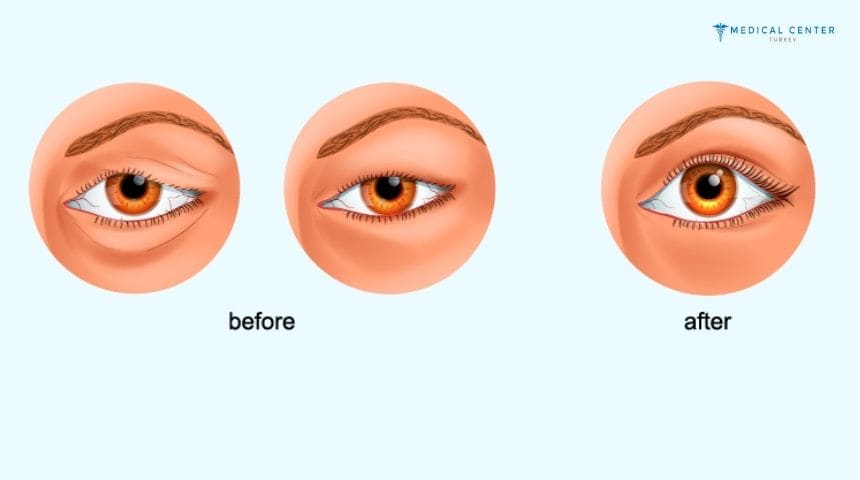 Bella Eyes Surgery in Turkey