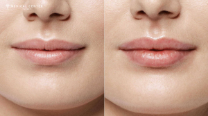  Do Lip Fillers Still Look Natural in 2026?