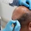 When Will You See Results After a Hair Transplant?