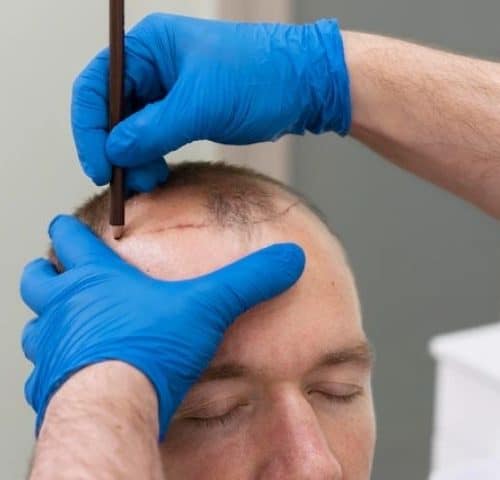 Why Does Turkey Still Delivers Top Results in Hair Transplants? Why Does Turkey Still Delivers Top Results in Hair Transplants?