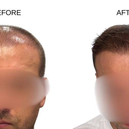 Canit’s Hair Transplant Experience in Turkey Canit’s Hair Transplant Experience in Turkey