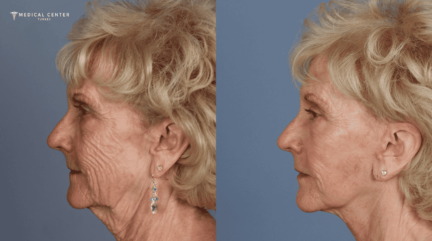 What’s New in Facelift Surgery in Turkey?