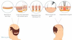 Which Hair Transplant Technique Works Best in 2026?