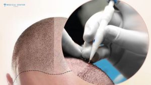 Which Hair Transplant Technique Works Best in 2026?