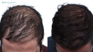 Which Hair Transplant Technique Works Best in 2026?