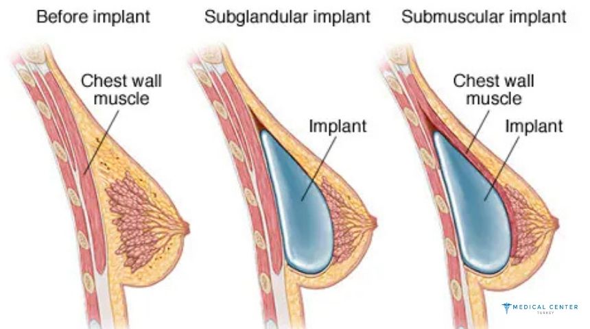 All Options For Breast Augmentation