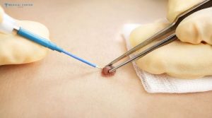 Is Mole Removal Still Popular in 2026?