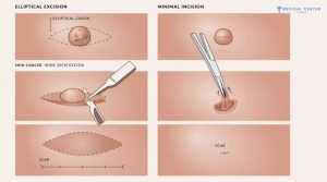 Is Mole Removal Still Popular in 2026?