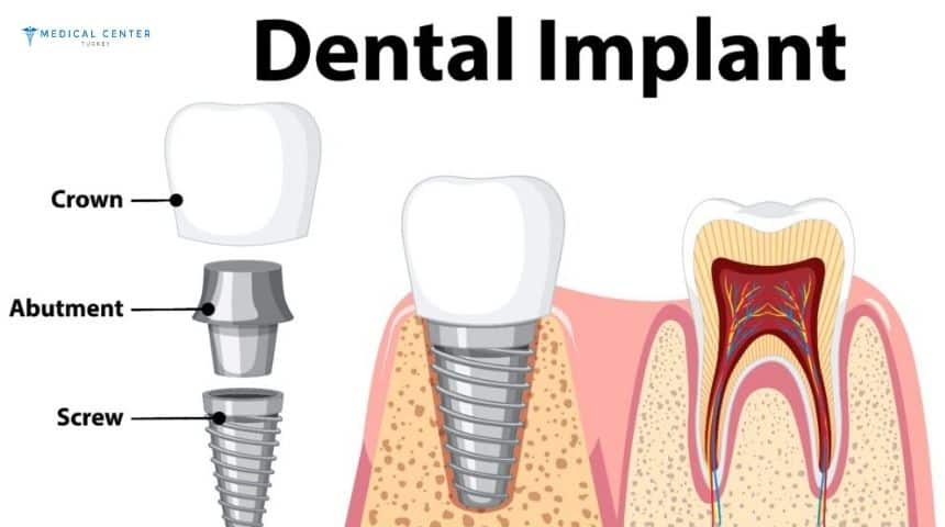 Which Dental Implant Option Is Best for You?