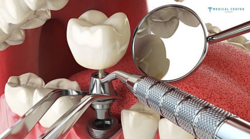 Which Dental Implant Option Is Best for You?