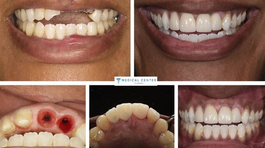 Which Dental Implant Option Is Best for You? 