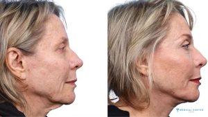 Why Deep Plane Facelifts are Trending?