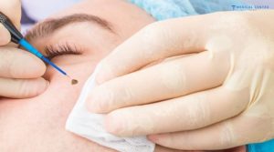 Is Mole Removal Still Popular in 2026?