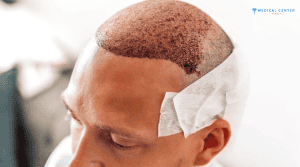 Top Reasons to Choose Turkey for Your Hair Transplant