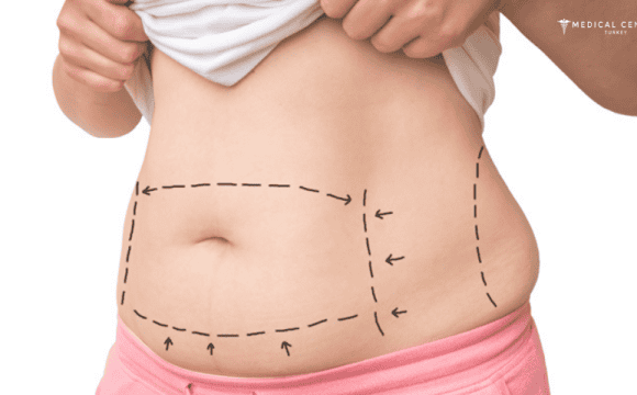 Which Tummy Tuck Option Should You Consider in 2026?