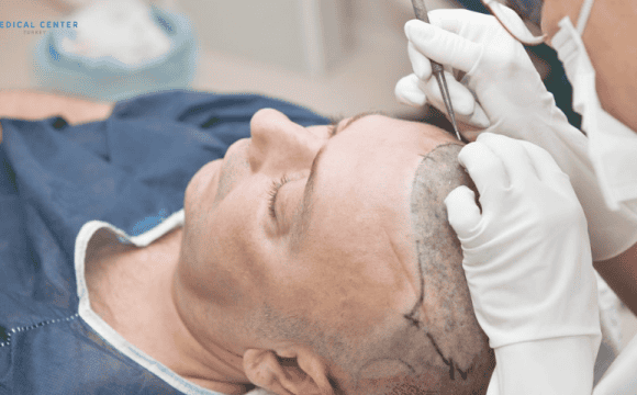 Top Reasons to Choose Turkey for Your Hair Transplant