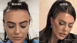 Top Reasons to Choose Turkey for Your Hair Transplant