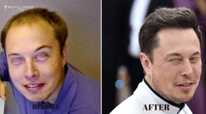 Top Reasons to Choose Turkey for Your Hair Transplant