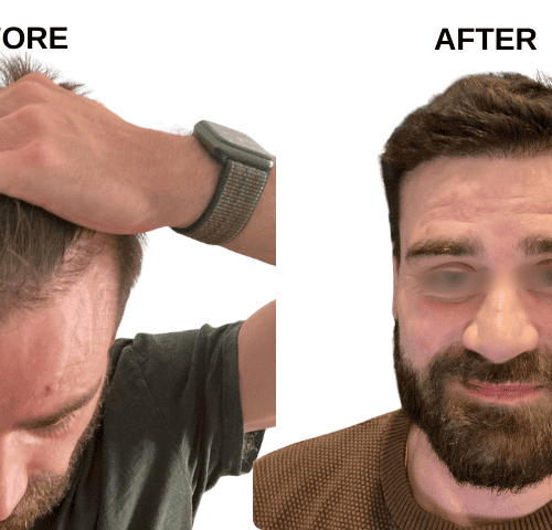 Jonathan Wickens Hair Transplant Experiences in Turkey Jonathan Wickens Hair Transplant Experiences in Turkey