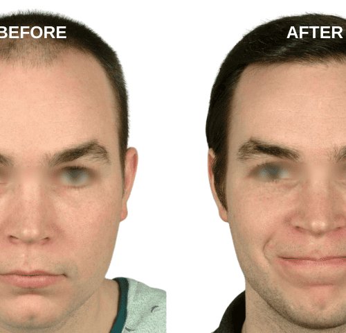 Jun Clapano Hair Transplant Experiences in Turkey Jun Clapano Hair Transplant Experiences in Turkey