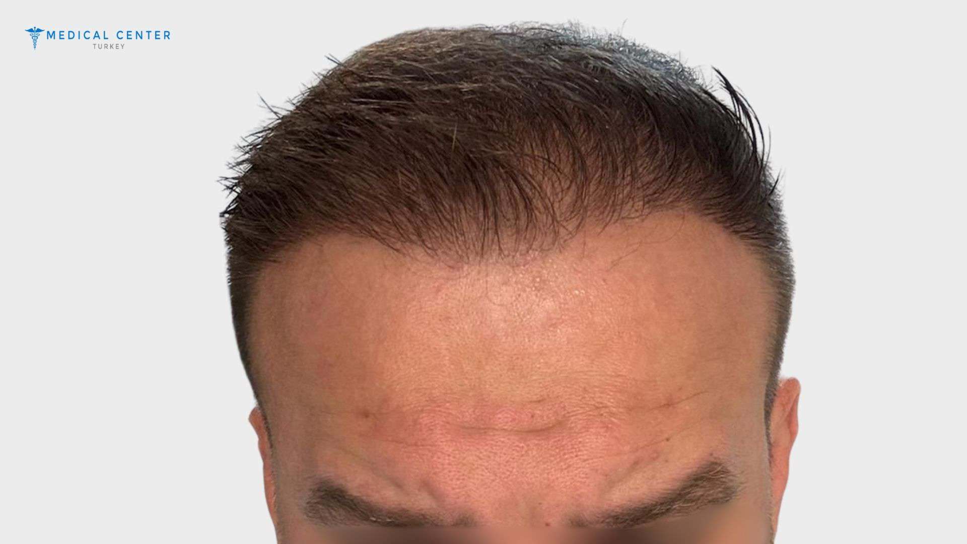 Canit’s Hair Transplant Experience in Turkey
