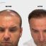 Canit’s Hair Transplant Experience in Turkey