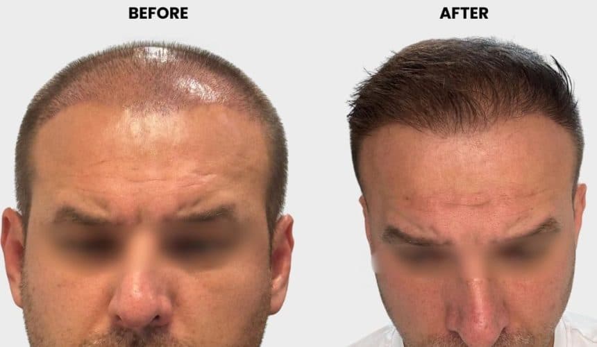 Canit’s Hair Transplant Experience in Turkey