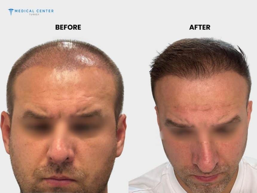 Canit’s Hair Transplant Experience in Turkey Canit’s Hair Transplant Experience in Turkey